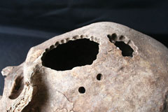 Peru-Trepanation-Skull