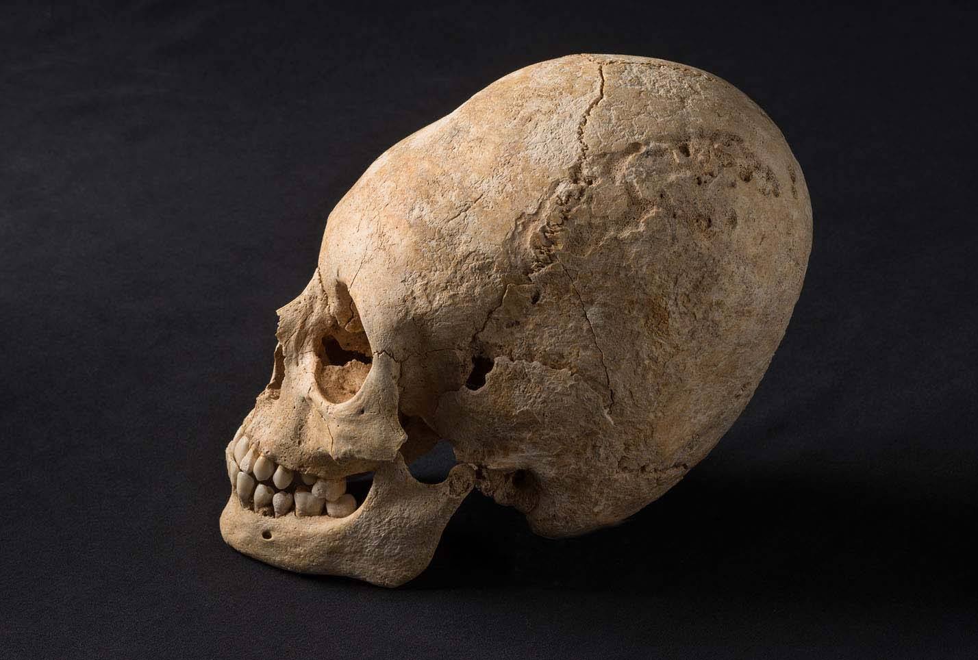 Alsace Hun Deformed Skull