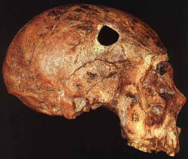 Saccpastore Neanderthal Skull