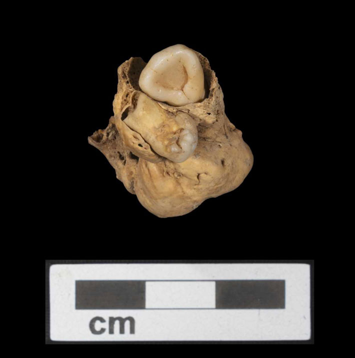 Egypt Amarna Teratoma