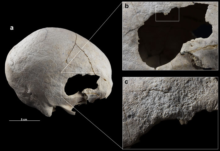 Spain Cranial Lesion