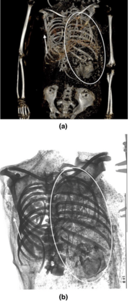 Egypt Pregnant Mummy