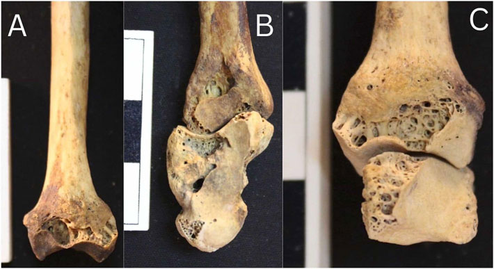 Egypt Skeleton Arthritis