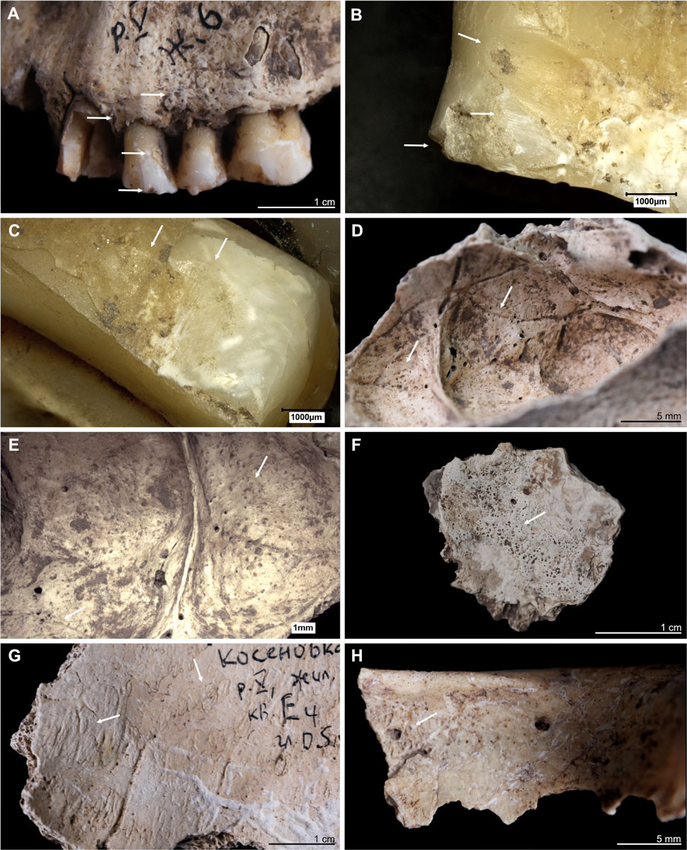 Teeth and bones from Kosenivka, Ukraine, showing a range of oral and pathological conditions