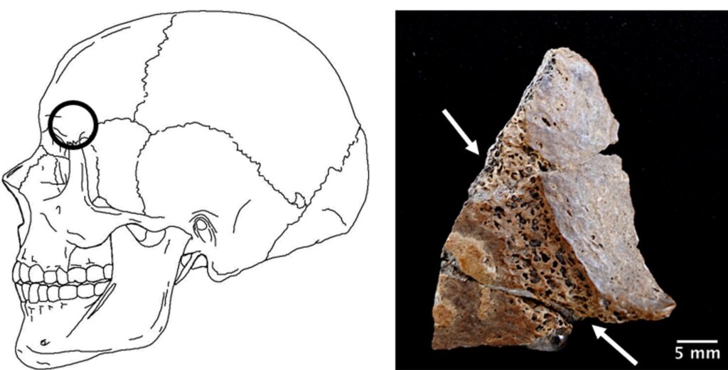 Human bone fragment (right) with markings indicating it had been removed with a beveled tool from a human skull (shown in drawing at left)