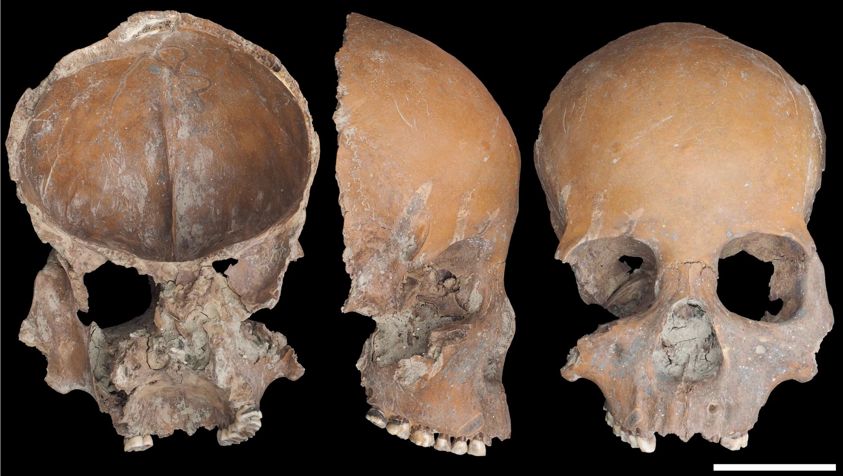 Mask-like facial skull