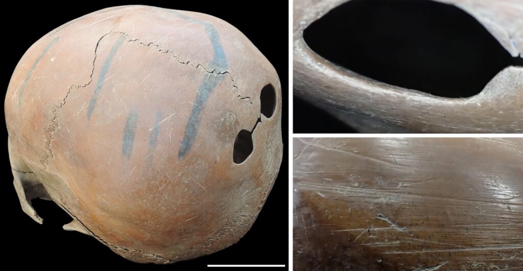 Skull with posterior perforations