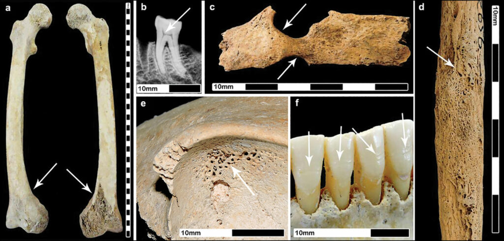 Indicators of stress on adult female skeletons dating to the Roman period