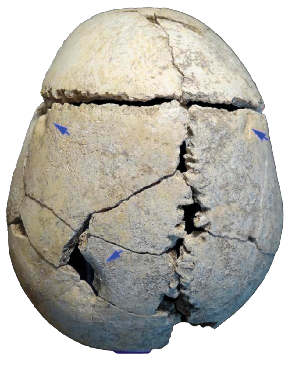 Skull of teenaged boy with arrows pointing to wounds from a lion attack