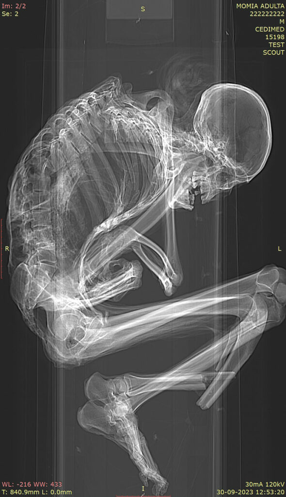 1,100-Year-Old Mummy Examined in Chile