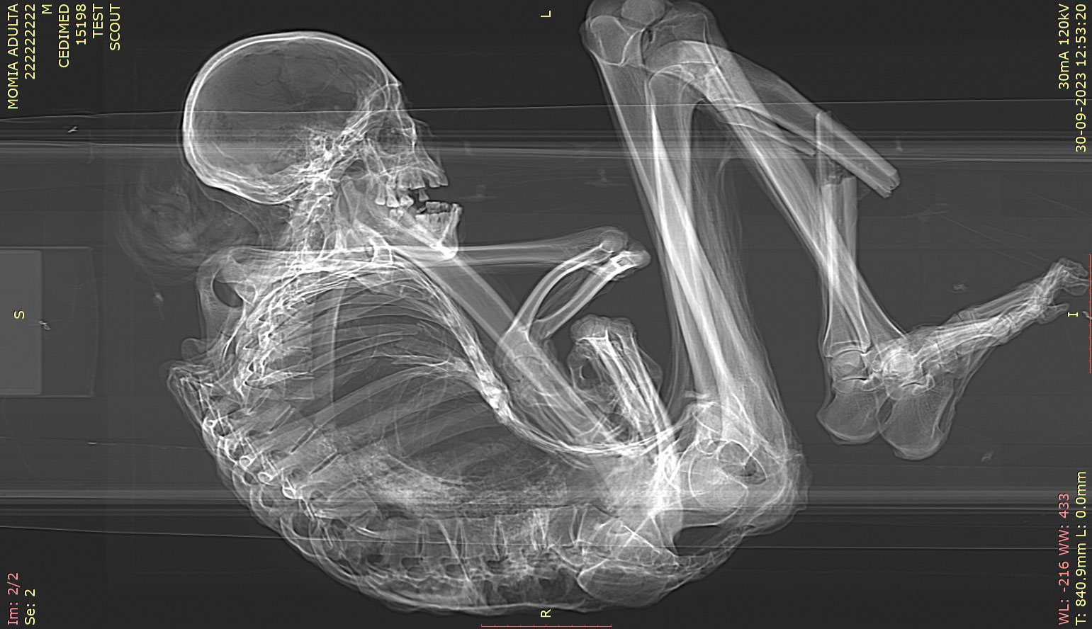 CT scan of mummified man