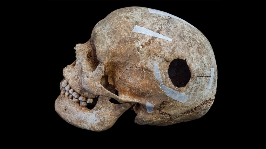 Skull with trepanation hole