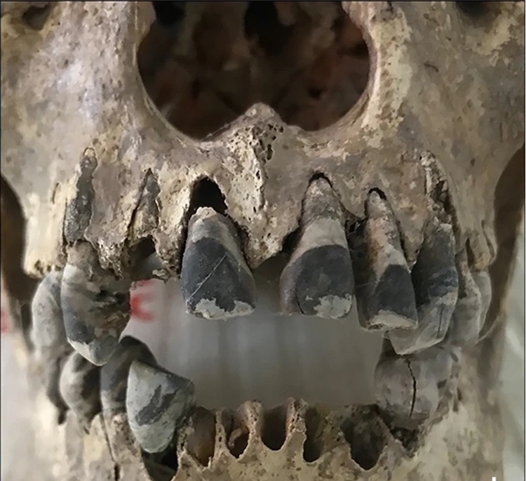 Black pigment layer on teeth from Dong Xa, Vietnam