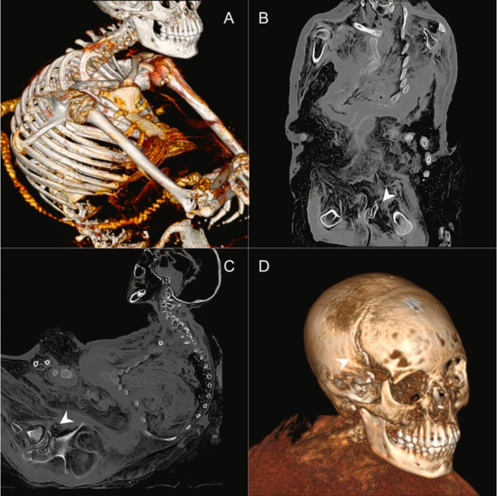 CT reconstructions of the remains of the "Lady of Ampato," showing areas of inflicted trauma