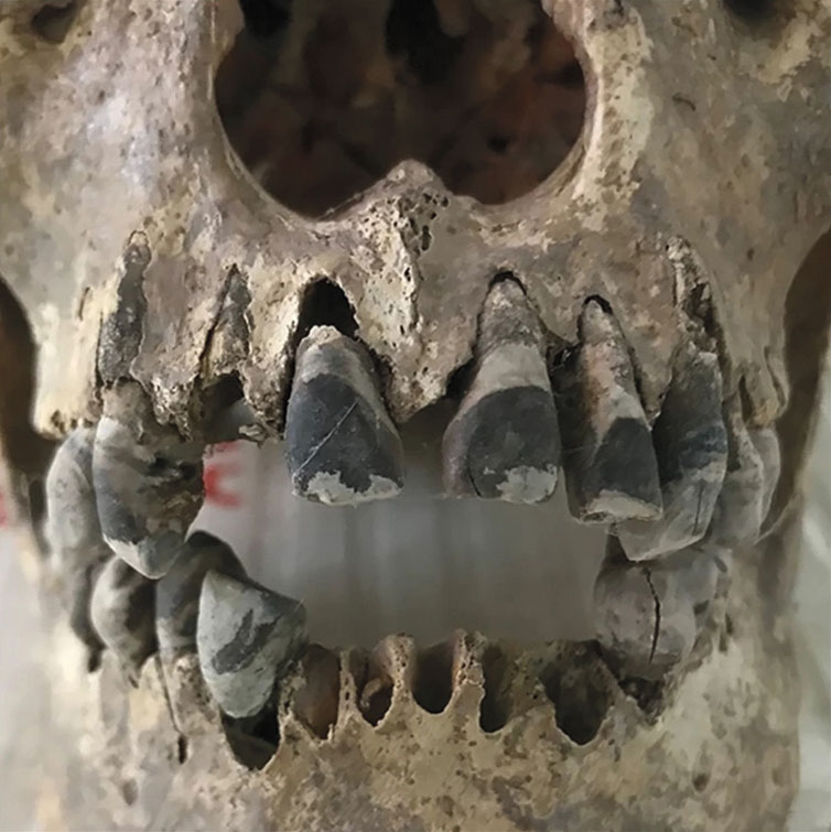 Blackened human teeth