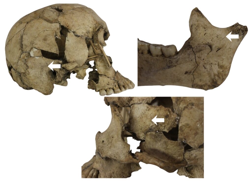 Remains with arrows showing the scurvy bleeds on the bone