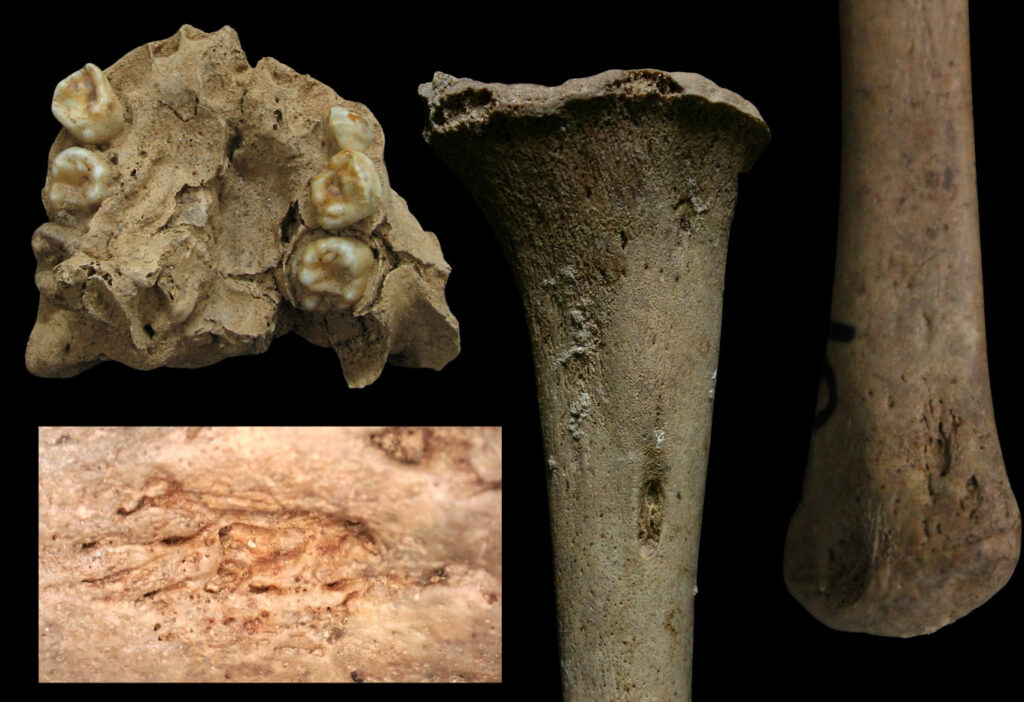Dental and skeletal lesions strongly indicate treponemal disease that spread from mother to infant in utero.