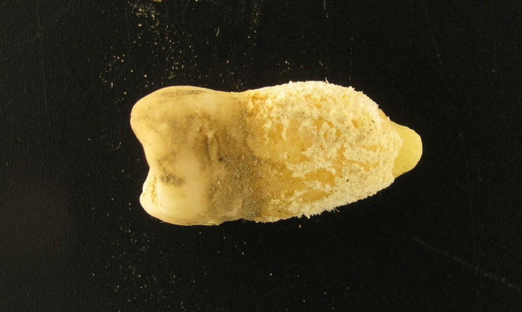 Tooth of a young man preserving the scarlet fever bacterium