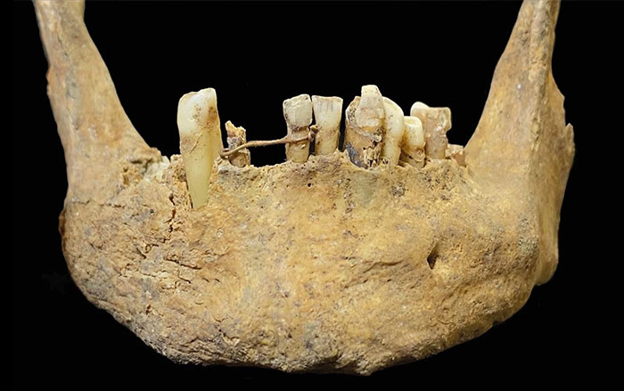 Gold ligature surrounding the left central incisor and the right lateral incisor on the mandible of an adult male buried in the East Kirk of the parish church of St. Nicholas, Aberdeen, Scotland