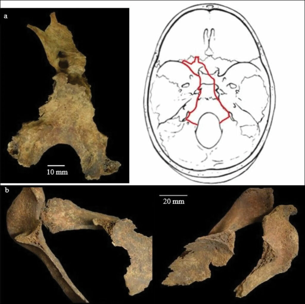 Cranial lesions and fractures
