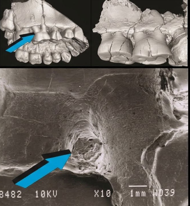 3D virtual reconstructions and SEM reveal horizontal alveolar bone loss in Plio-Pleistocene hominin fossil remains