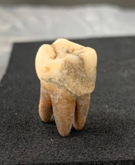 Example of dental calculus attached to an ancient human tooth from the Umeda cemetery in Osaka, Japan