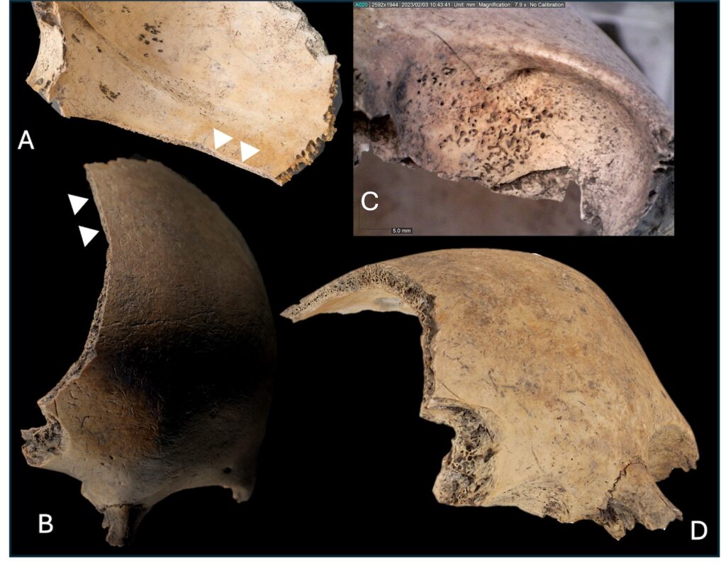 Skull of a child from Aalborg, Denmark, seen from different angles, showing the damage from a sword cut.
