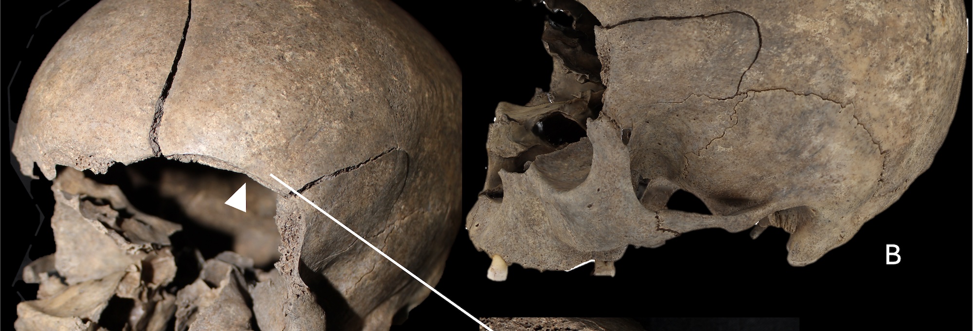 This skull of a Viking Age woman bears traces of head injuries.