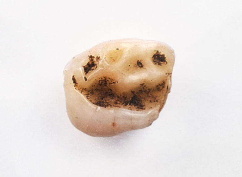 Mesolithic baby tooth
